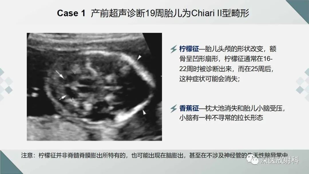 影像PPT - 【PPT】胎儿和新生儿后颅窝畸形的影像诊断-36
