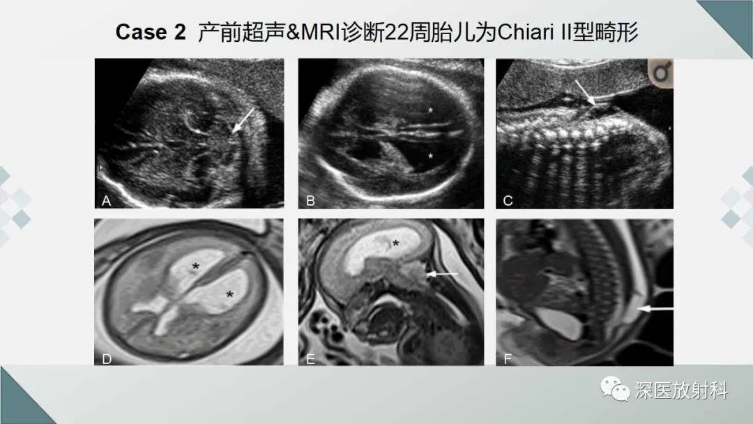 影像PPT - 【PPT】胎儿和新生儿后颅窝畸形的影像诊断-37