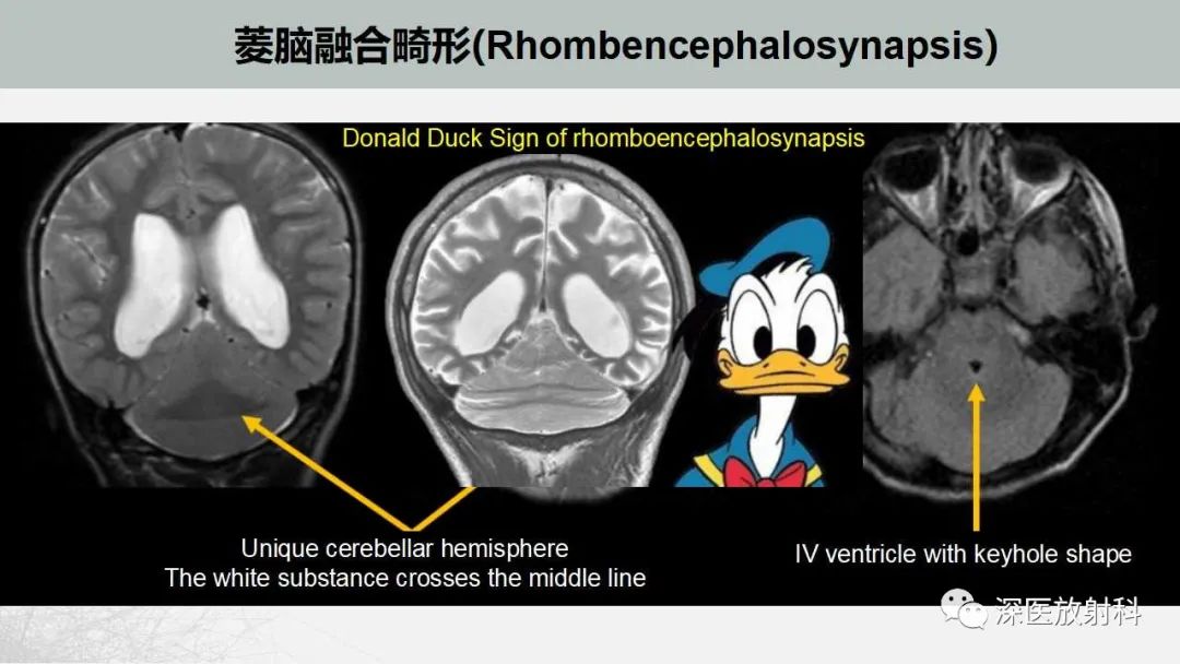 影像PPT - 【PPT】胎儿和新生儿后颅窝畸形的影像诊断-39