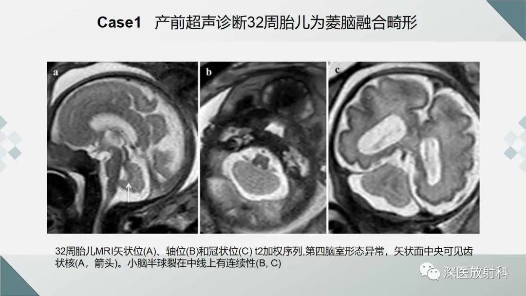 影像PPT - 【PPT】胎儿和新生儿后颅窝畸形的影像诊断-40