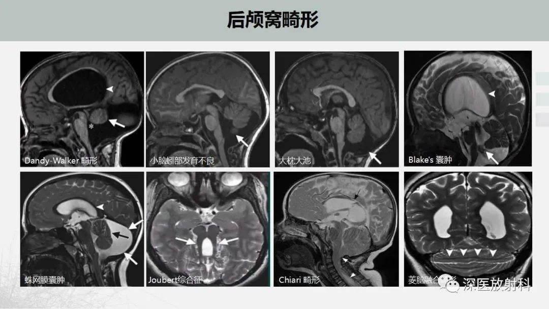 影像PPT - 【PPT】胎儿和新生儿后颅窝畸形的影像诊断-45