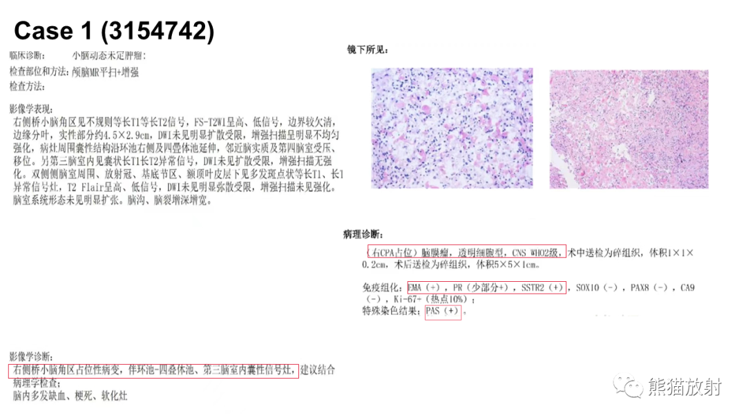 影像PPT - 【PPT】桥小脑角区CPA脑膜瘤 VS 神经鞘瘤-12