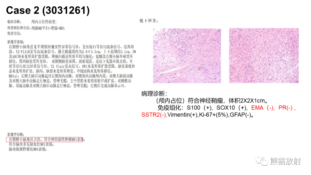 影像PPT - 【PPT】桥小脑角区CPA脑膜瘤 VS 神经鞘瘤-13