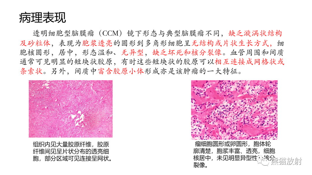 影像PPT - 【PPT】桥小脑角区CPA脑膜瘤 VS 神经鞘瘤-18