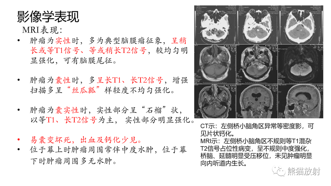 影像PPT - 【PPT】桥小脑角区CPA脑膜瘤 VS 神经鞘瘤-20