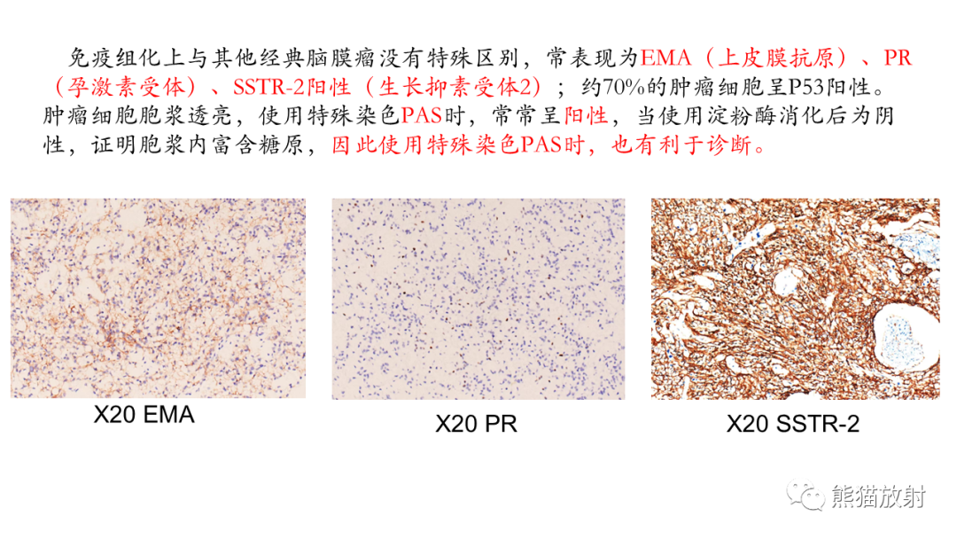 影像PPT - 【PPT】桥小脑角区CPA脑膜瘤 VS 神经鞘瘤-19