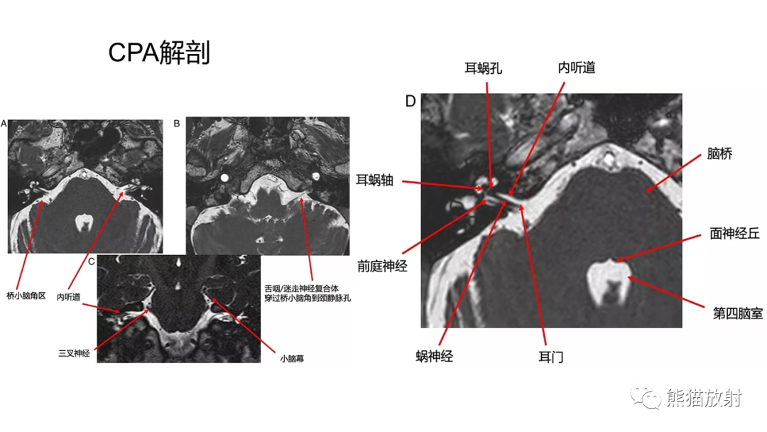 影像PPT - 【PPT】桥小脑角区CPA脑膜瘤 VS 神经鞘瘤-21