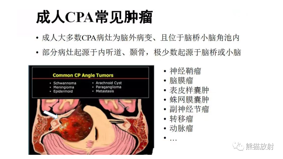 影像PPT - 【PPT】桥小脑角区CPA脑膜瘤 VS 神经鞘瘤-22