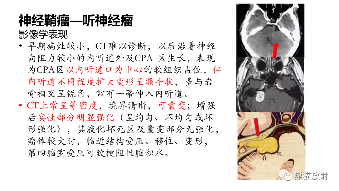影像PPT - 【PPT】桥小脑角区CPA脑膜瘤 VS 神经鞘瘤-26