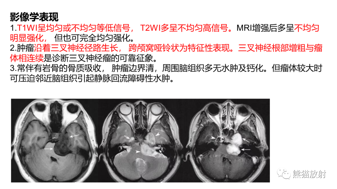 影像PPT - 【PPT】桥小脑角区CPA脑膜瘤 VS 神经鞘瘤-29