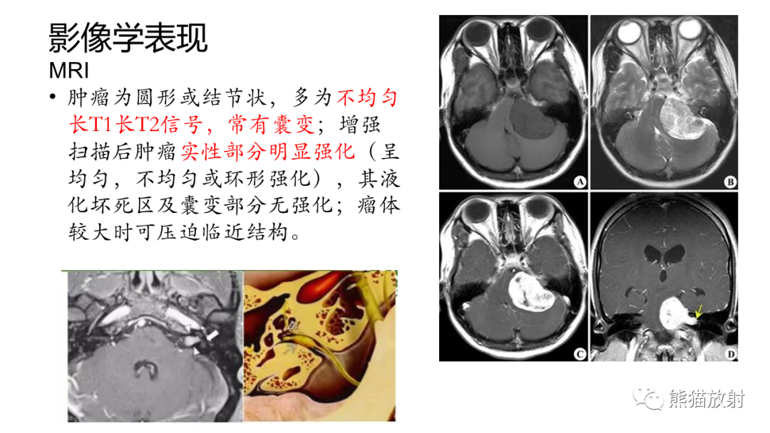 影像PPT - 【PPT】桥小脑角区CPA脑膜瘤 VS 神经鞘瘤-27