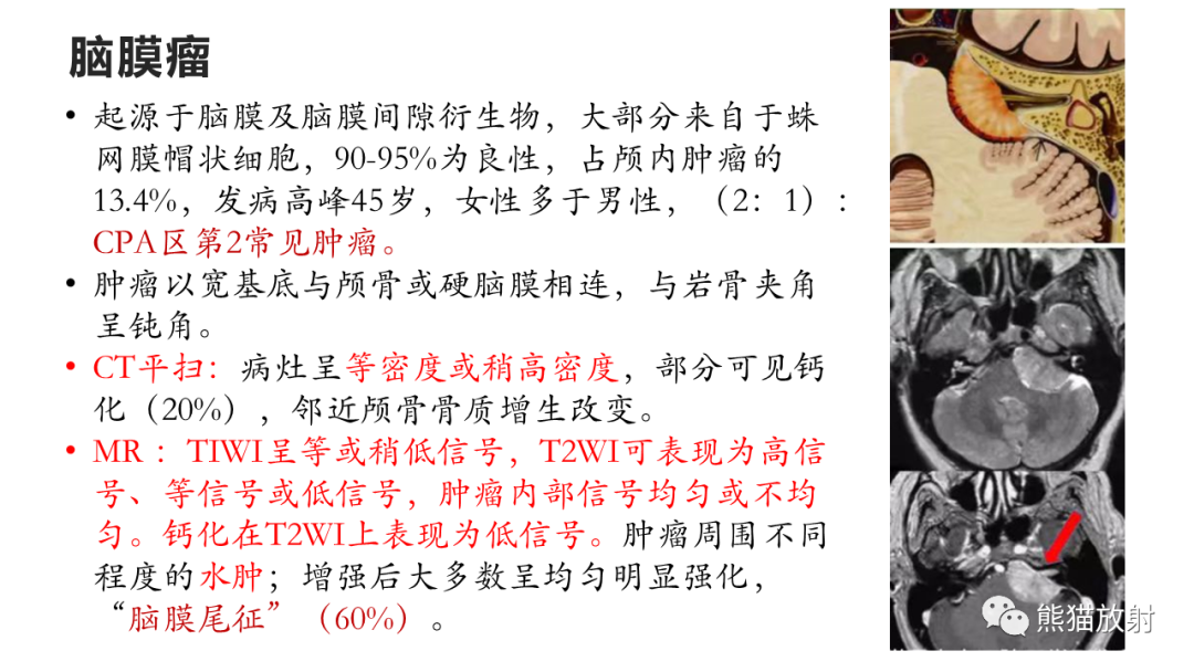 影像PPT - 【PPT】桥小脑角区CPA脑膜瘤 VS 神经鞘瘤-30