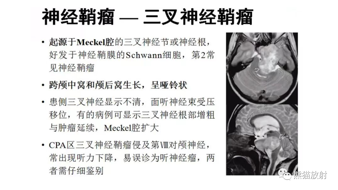 影像PPT - 【PPT】桥小脑角区CPA脑膜瘤 VS 神经鞘瘤-28