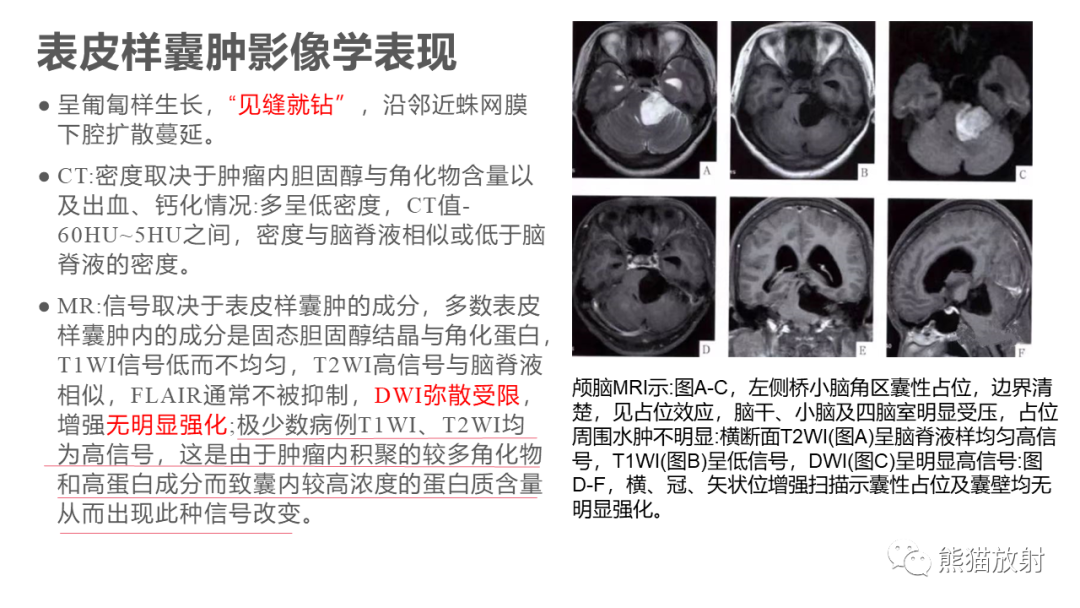 影像PPT - 【PPT】桥小脑角区CPA脑膜瘤 VS 神经鞘瘤-32