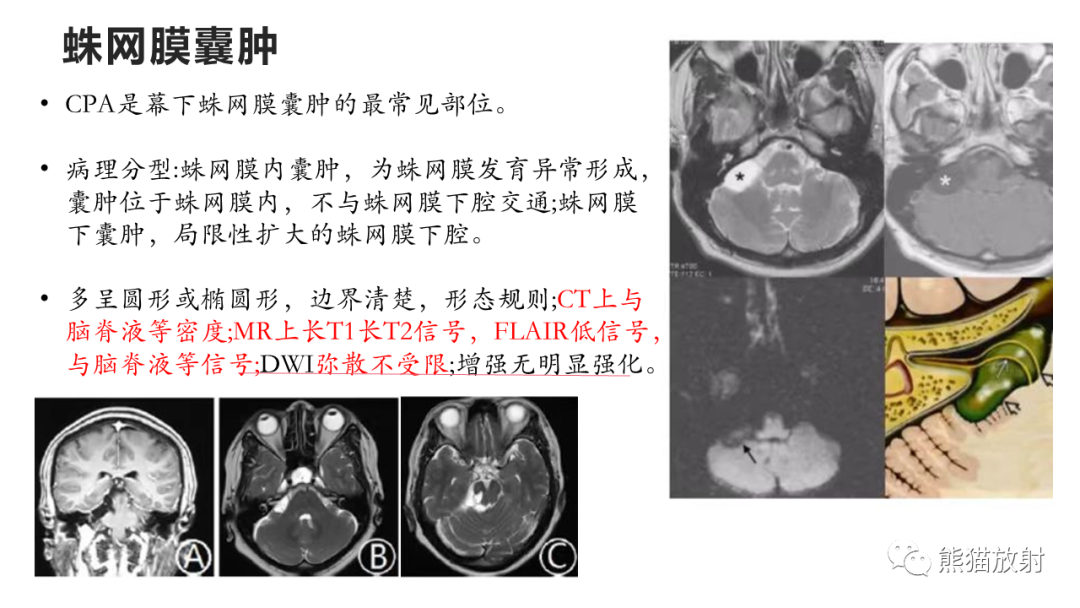 影像PPT - 【PPT】桥小脑角区CPA脑膜瘤 VS 神经鞘瘤-33