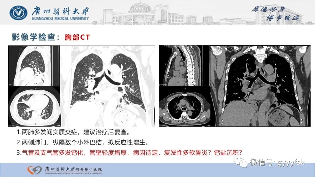 影像PPT - 【病例】复发性多软骨炎1例CT影像-4