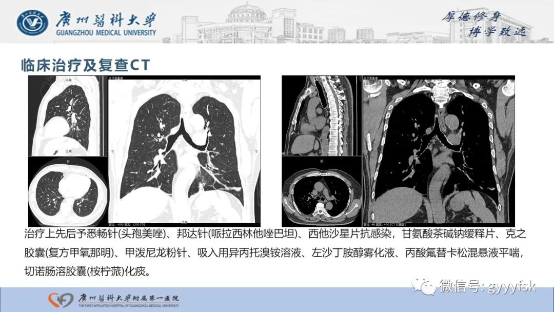 影像PPT - 【病例】复发性多软骨炎1例CT影像-5