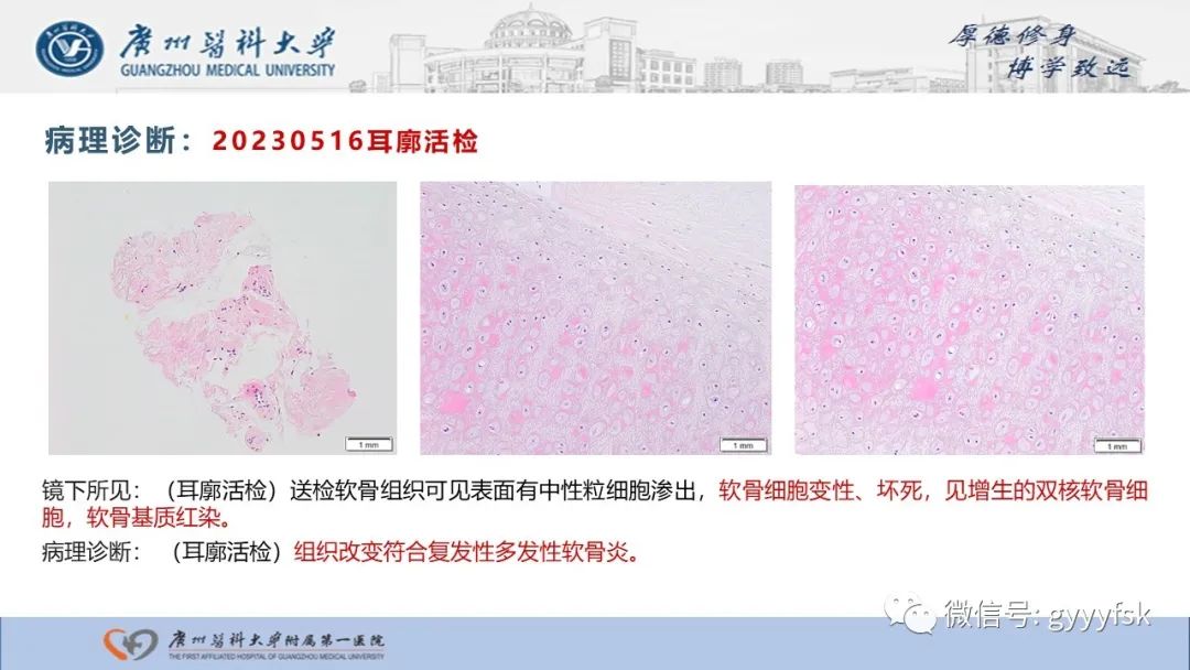 影像PPT - 【病例】复发性多软骨炎1例CT影像-7