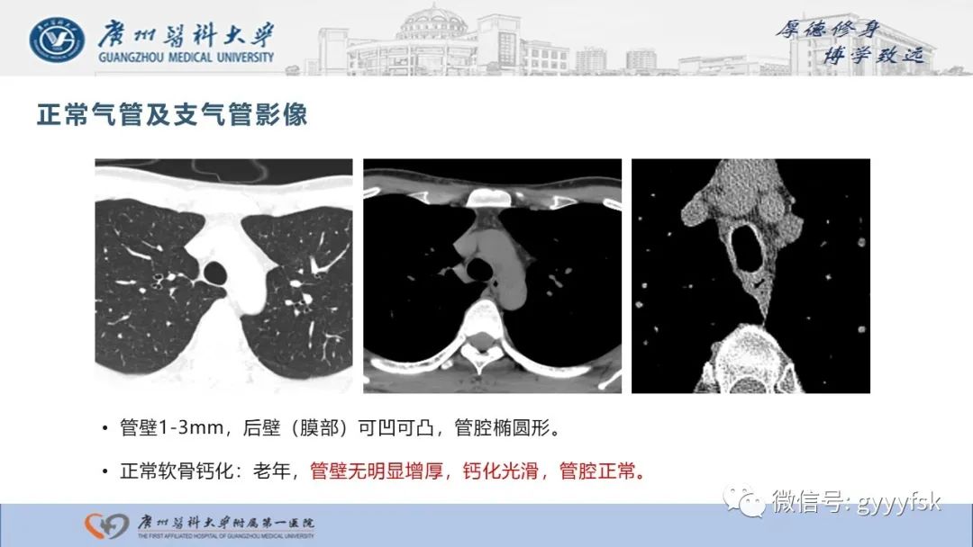 影像PPT - 【病例】复发性多软骨炎1例CT影像-9