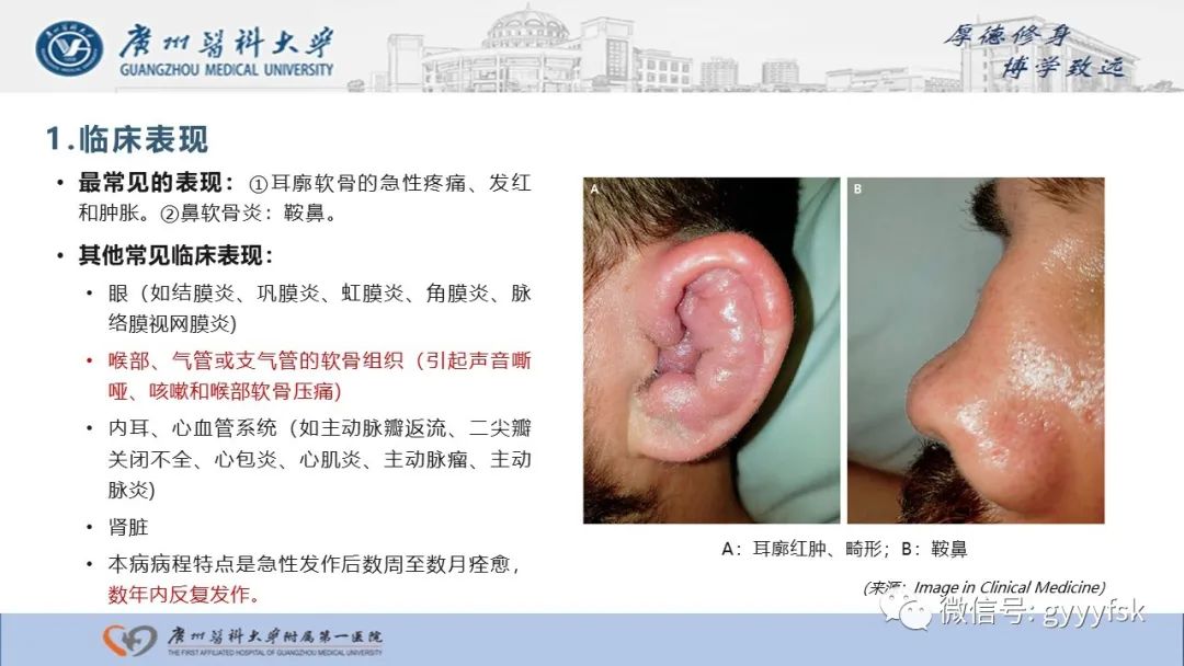 影像PPT - 【病例】复发性多软骨炎1例CT影像-12