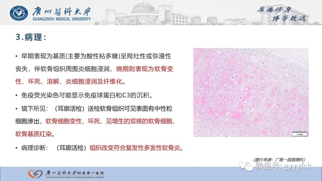 影像PPT - 【病例】复发性多软骨炎1例CT影像-14