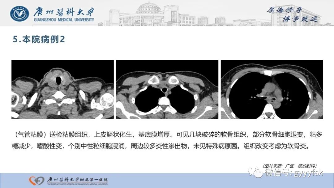 影像PPT - 【病例】复发性多软骨炎1例CT影像-16
