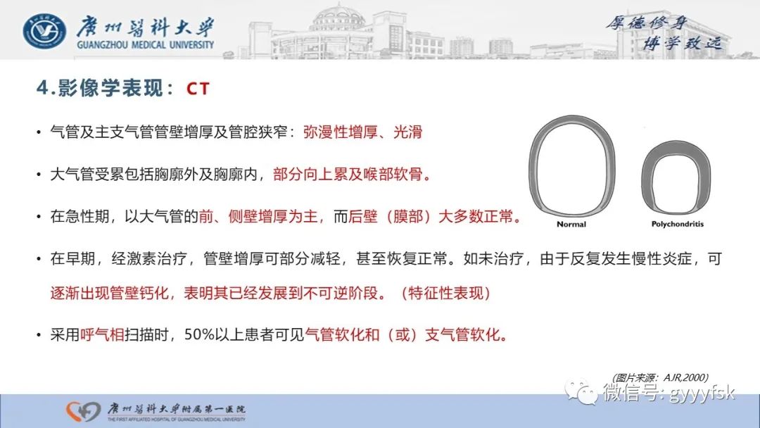 影像PPT - 【病例】复发性多软骨炎1例CT影像-15