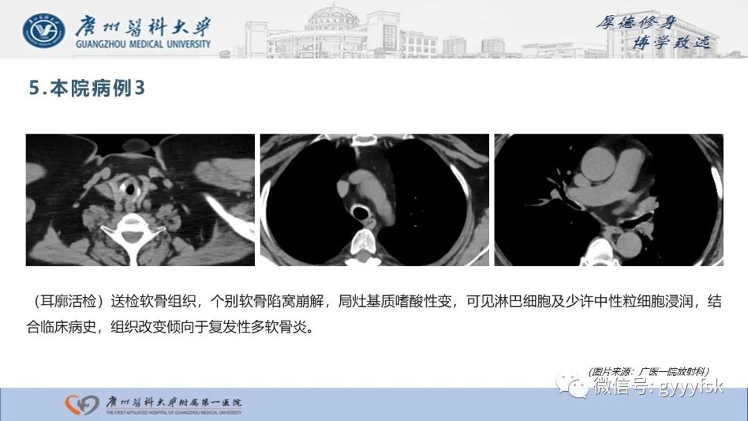 影像PPT - 【病例】复发性多软骨炎1例CT影像-17