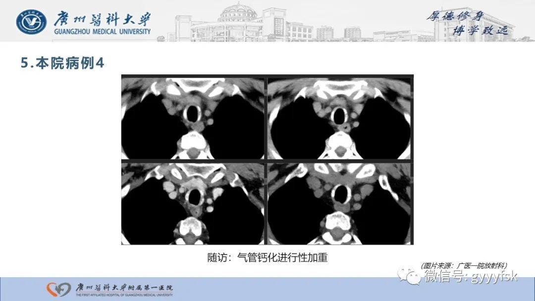 影像PPT - 【病例】复发性多软骨炎1例CT影像-18