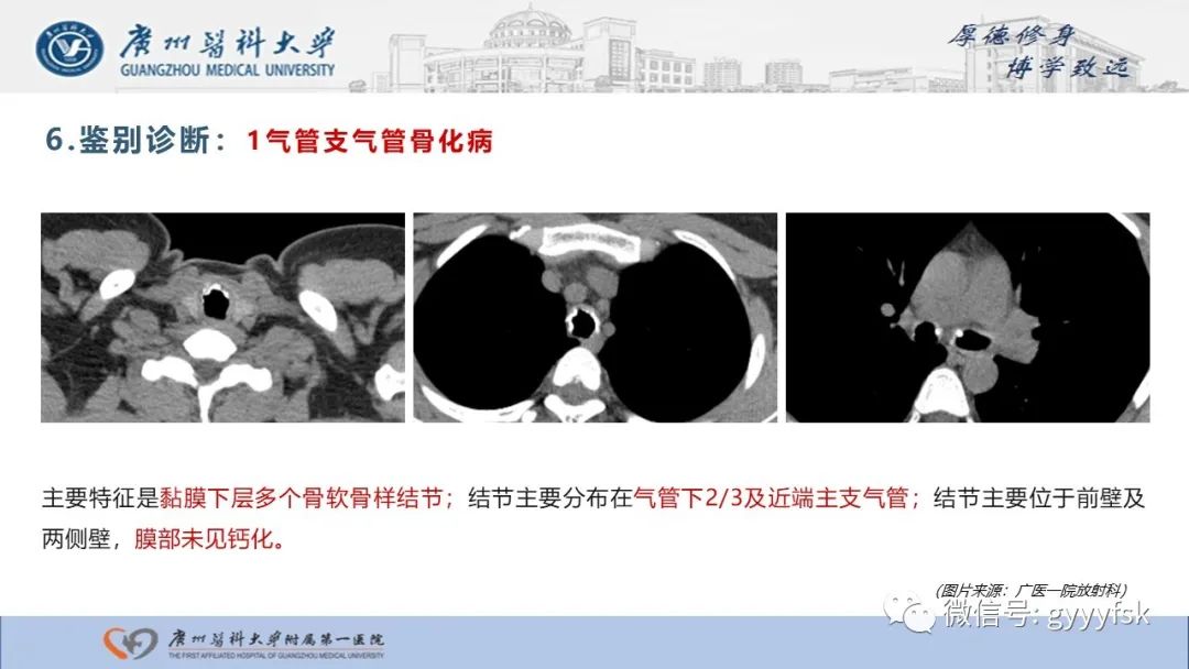 影像PPT - 【病例】复发性多软骨炎1例CT影像-21