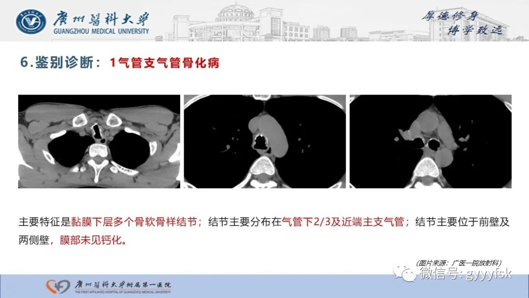 影像PPT - 【病例】复发性多软骨炎1例CT影像-22