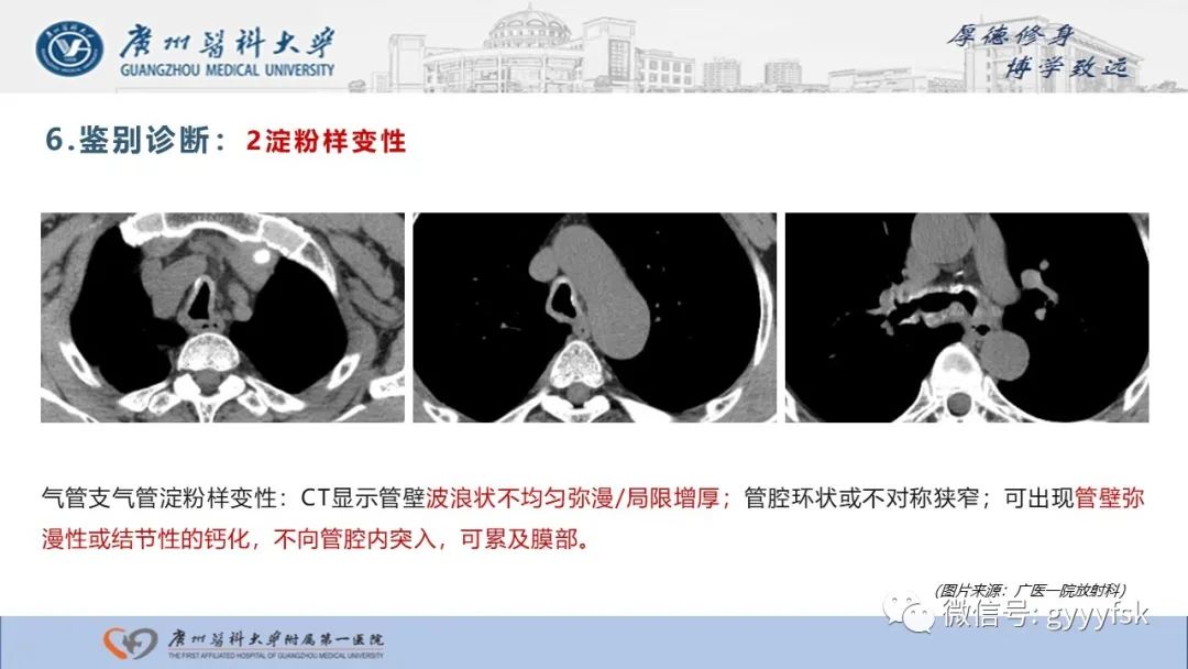 影像PPT - 【病例】复发性多软骨炎1例CT影像-23