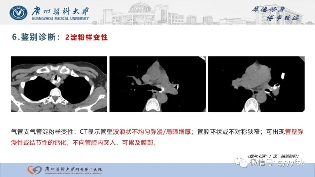 影像PPT - 【病例】复发性多软骨炎1例CT影像-24