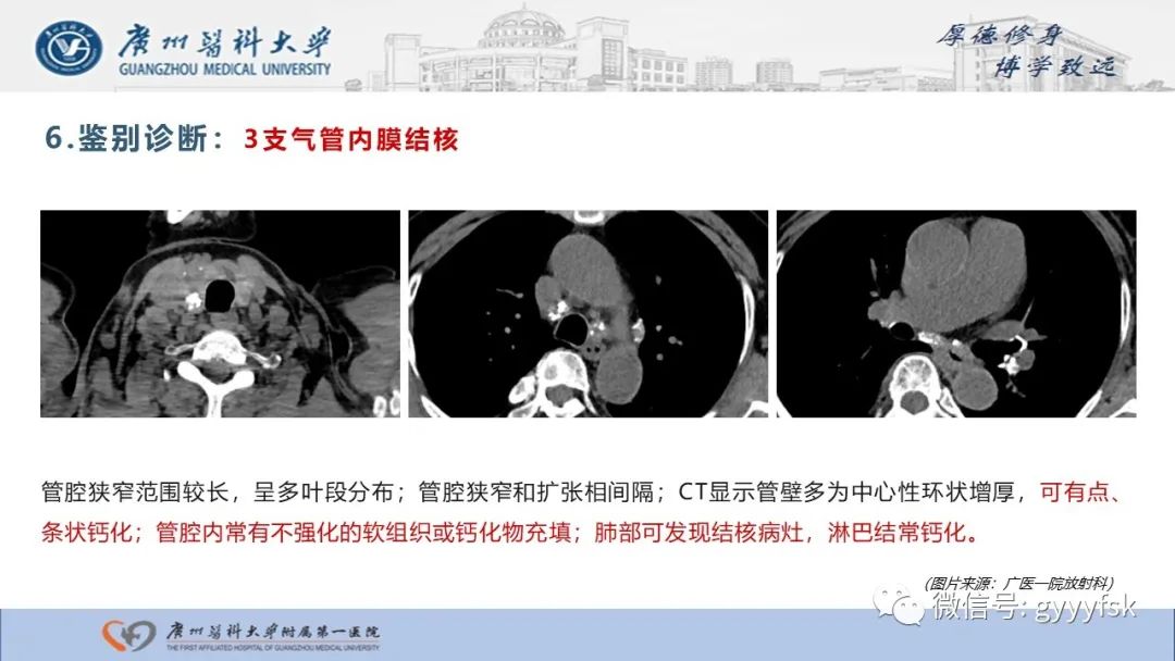 影像PPT - 【病例】复发性多软骨炎1例CT影像-25