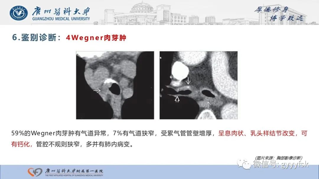 影像PPT - 【病例】复发性多软骨炎1例CT影像-26
