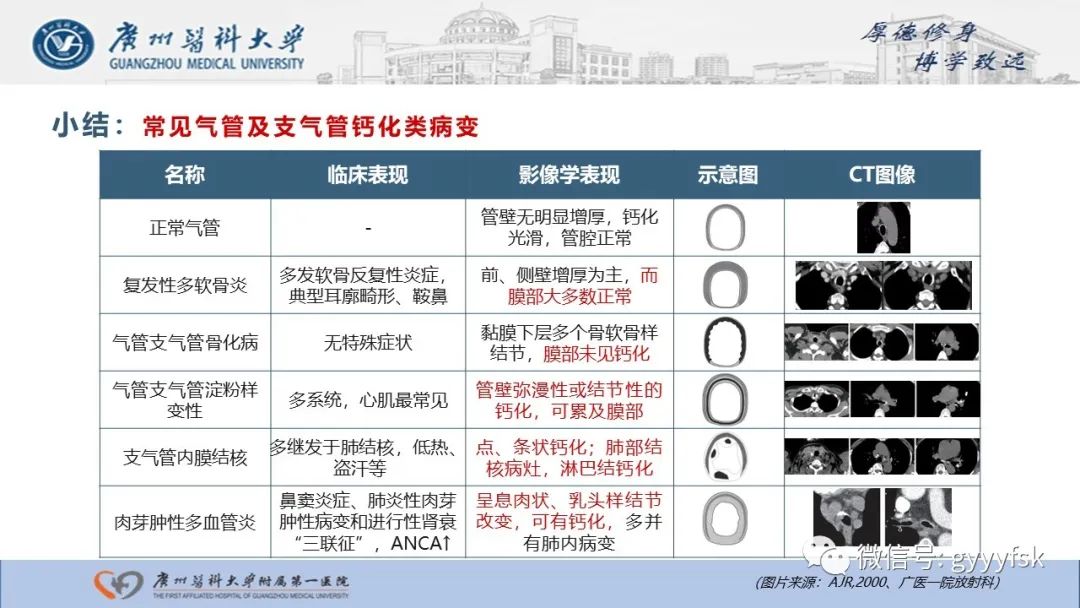 影像PPT - 【病例】复发性多软骨炎1例CT影像-27
