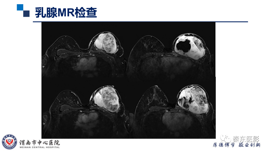 影像PPT - 【PPT】乳腺叶状肿瘤的影像表现-5