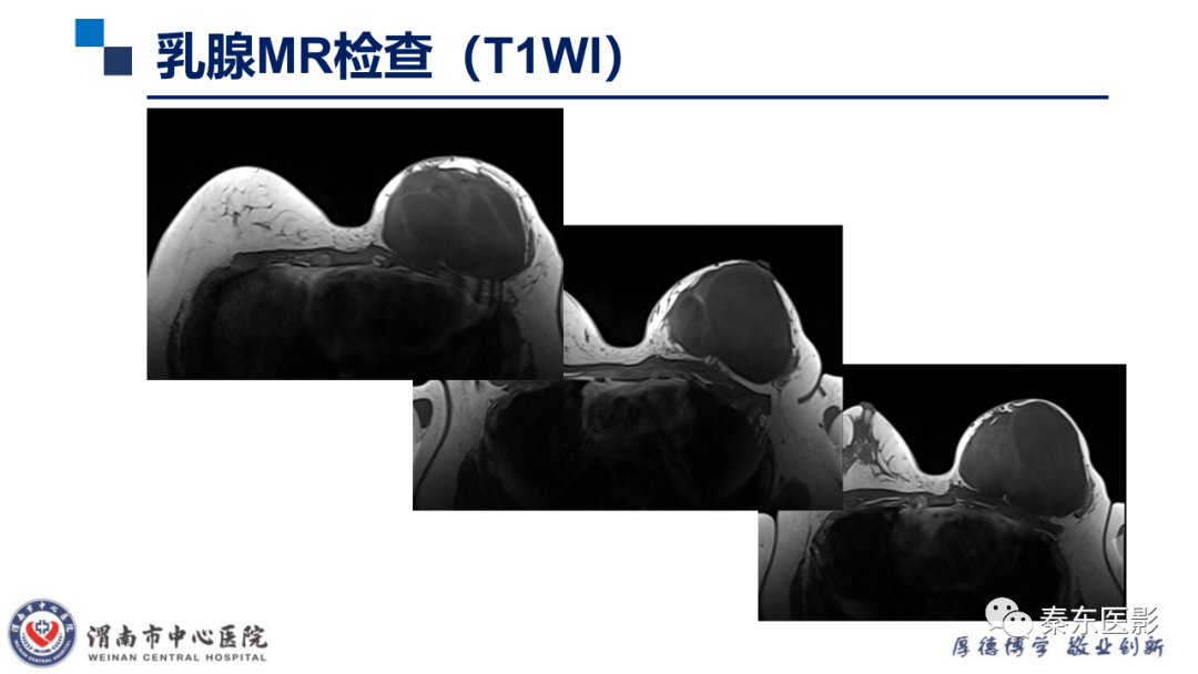 影像PPT - 【PPT】乳腺叶状肿瘤的影像表现-3
