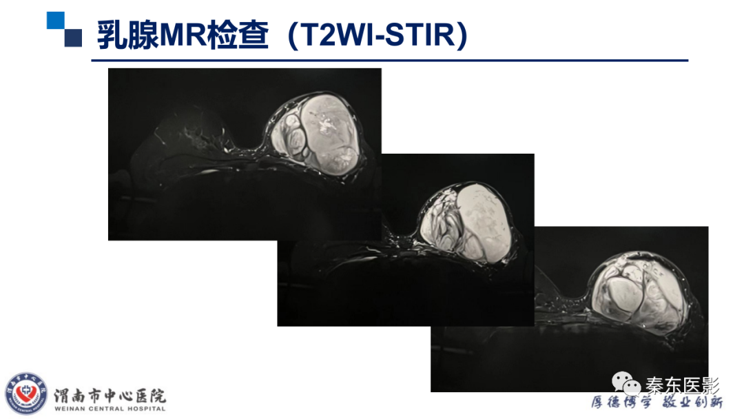 影像PPT - 【PPT】乳腺叶状肿瘤的影像表现-4