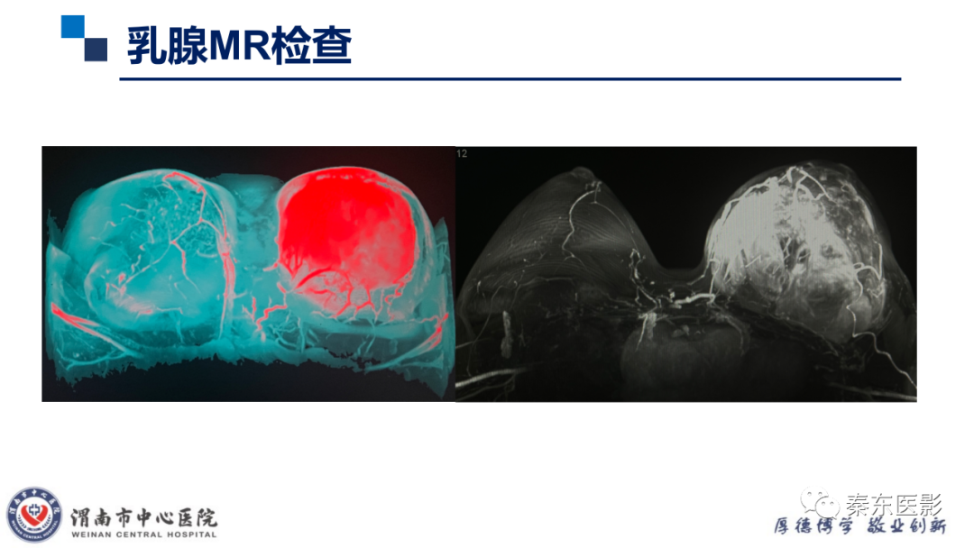 影像PPT - 【PPT】乳腺叶状肿瘤的影像表现-7