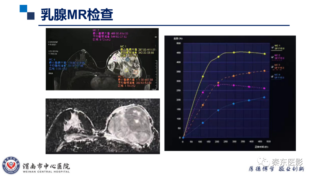 影像PPT - 【PPT】乳腺叶状肿瘤的影像表现-8
