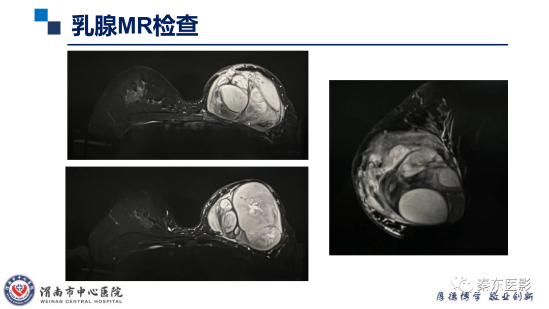 影像PPT - 【PPT】乳腺叶状肿瘤的影像表现-9
