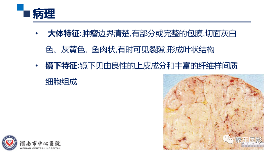 影像PPT - 【PPT】乳腺叶状肿瘤的影像表现-18