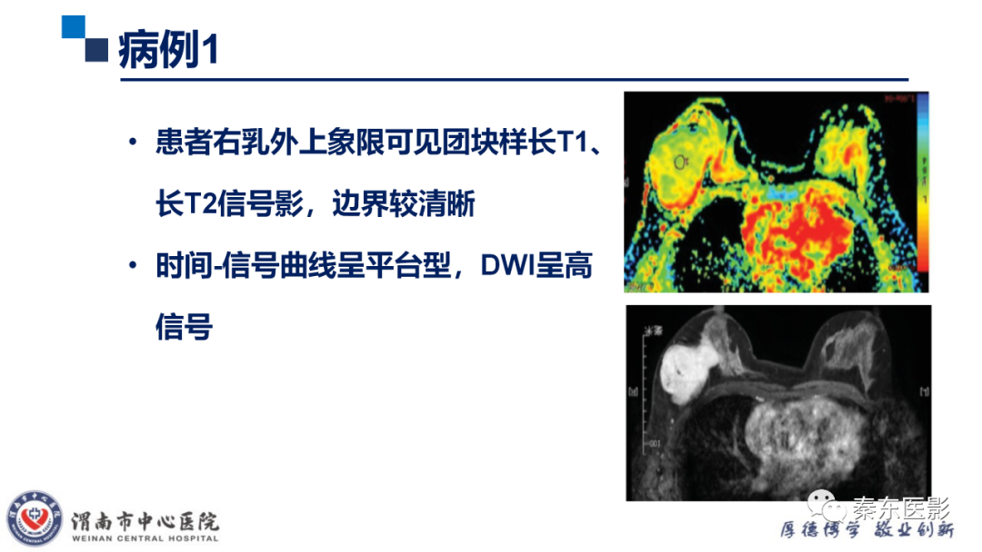 影像PPT - 【PPT】乳腺叶状肿瘤的影像表现-23
