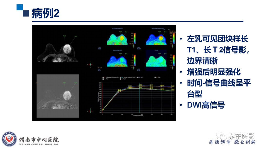 影像PPT - 【PPT】乳腺叶状肿瘤的影像表现-25
