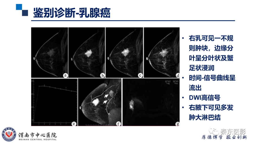 影像PPT - 【PPT】乳腺叶状肿瘤的影像表现-28