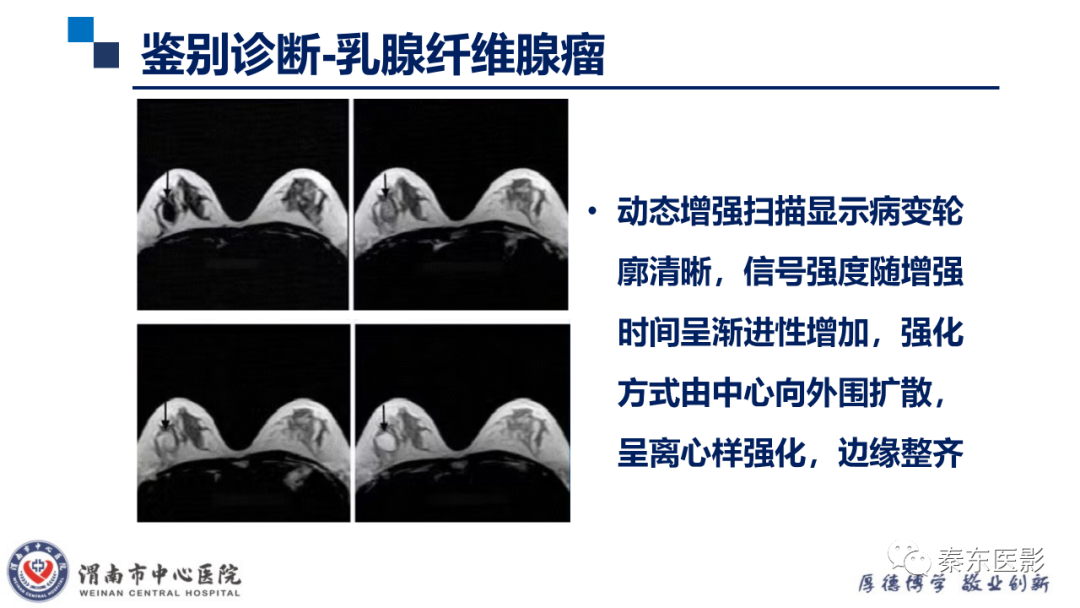 影像PPT - 【PPT】乳腺叶状肿瘤的影像表现-30