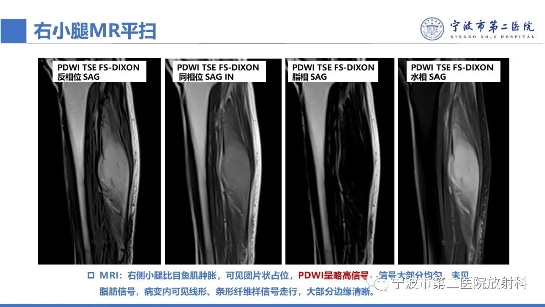 影像PPT - 【PPT】增生性肌炎-5