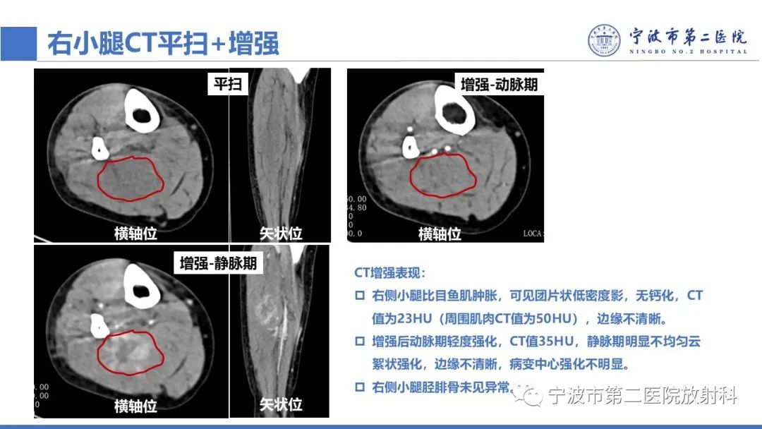 影像PPT - 【PPT】增生性肌炎-4