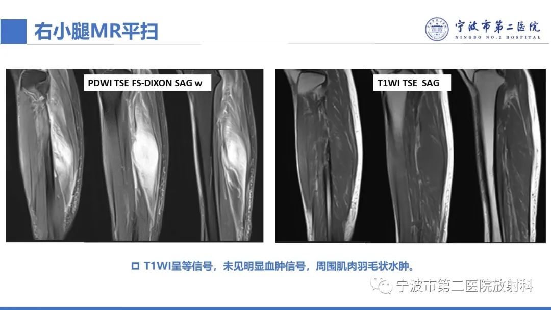 影像PPT - 【PPT】增生性肌炎-6